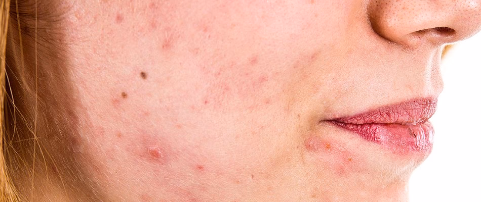 W którym roku trądzik jest najgorszy?